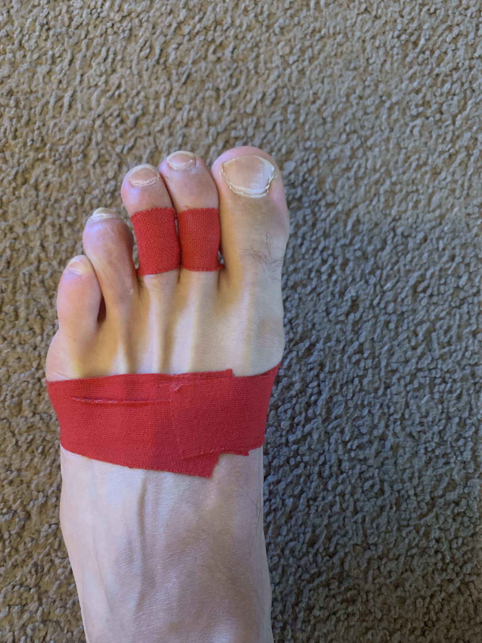 how-to-tape-toes-for-plantar-plate-tear-plantar-health