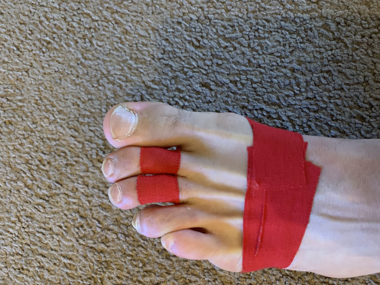 What Is The Recovery Time For Plantar Plate Tear Surgery