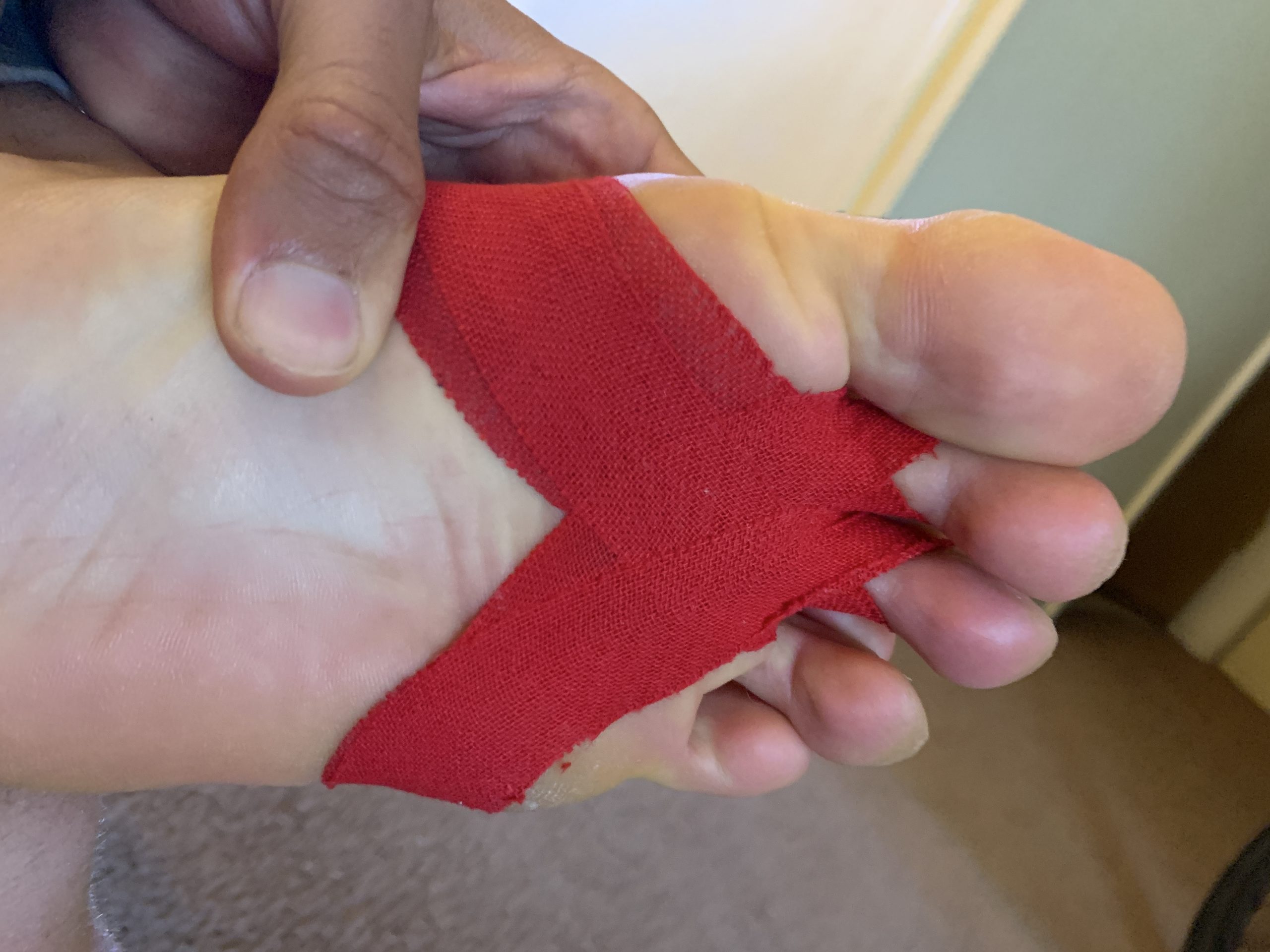 Plantar Fascia Rupture Treatment: What To Expect