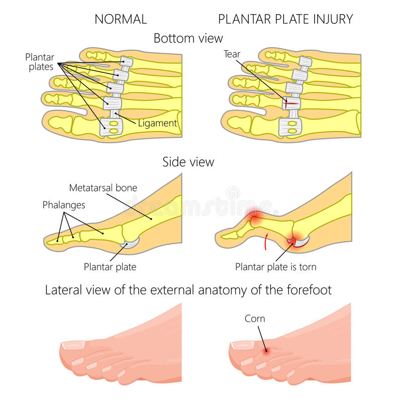 i-think-i-have-a-plantar-plate-tear-plantar-health